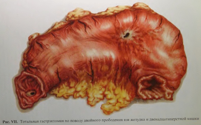 Иллюстрация к книге — Этюды желудочной хирургии [i_135.jpg]