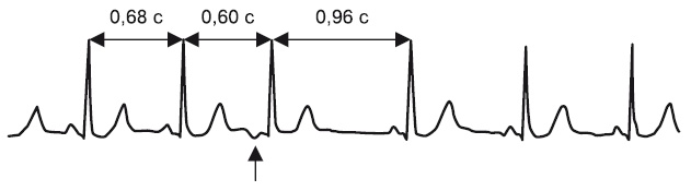 Иллюстрация к книге — Что показывает кардиограмма [i_045.jpg]