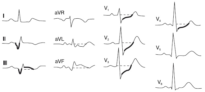 Иллюстрация к книге — Что показывает кардиограмма [i_053.jpg]