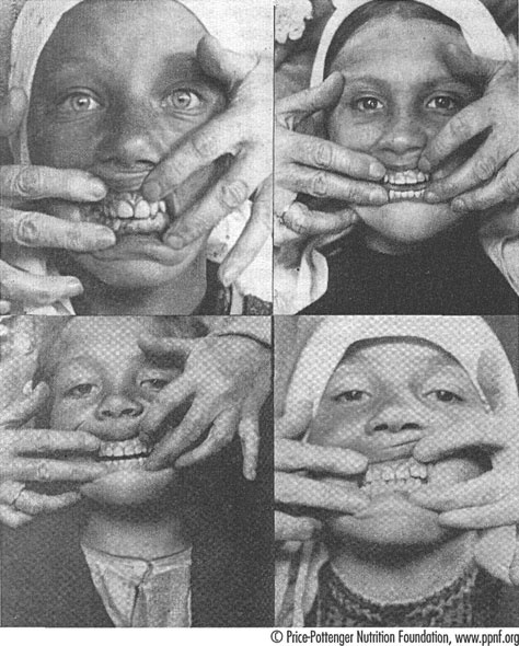 Иллюстрация к книге — Естественное лечение кариеса. Реминерализация и восстановление зубов при помощи питания [i_002.jpg]