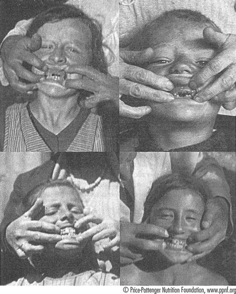 Иллюстрация к книге — Естественное лечение кариеса. Реминерализация и восстановление зубов при помощи питания [i_003.jpg]