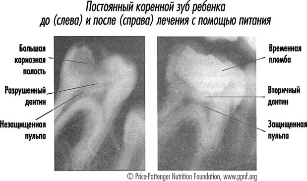 Иллюстрация к книге — Естественное лечение кариеса. Реминерализация и восстановление зубов при помощи питания [i_026.jpg]