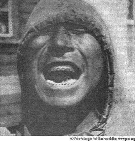 Иллюстрация к книге — Естественное лечение кариеса. Реминерализация и восстановление зубов при помощи питания [i_027.jpg]