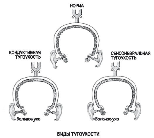 Иллюстрация к книге — Почему болит ухо. Что делать при отитах, снижении слуха и звоне в ушах – правила доказательной медицины [i_039.jpg]