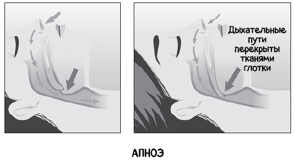 Иллюстрация к книге — Почему болит горло. Першение, кашель, боль, храп – как не пропустить опасные симптомы [i_031.jpg]