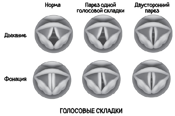 Иллюстрация к книге — Почему болит горло. Першение, кашель, боль, храп – как не пропустить опасные симптомы [i_042.jpg]