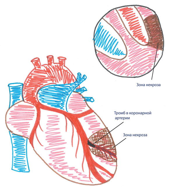 Иллюстрация к книге — Как жить после инфаркта [i_007.jpg]