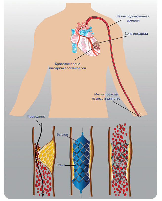 Иллюстрация к книге — Как жить после инфаркта [i_019.jpg]