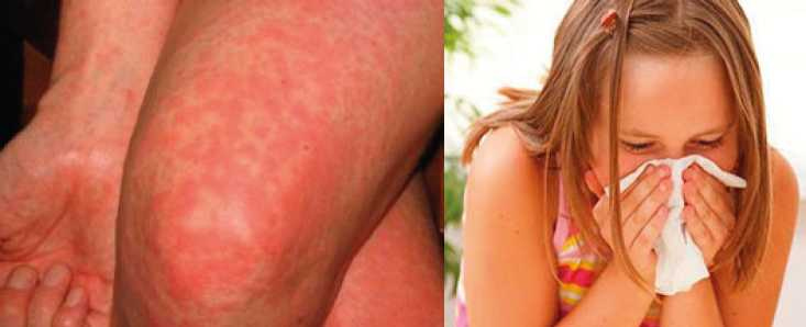 Иллюстрация к книге — Аллергия. Истинные причины. Лечение [i_035.jpg]