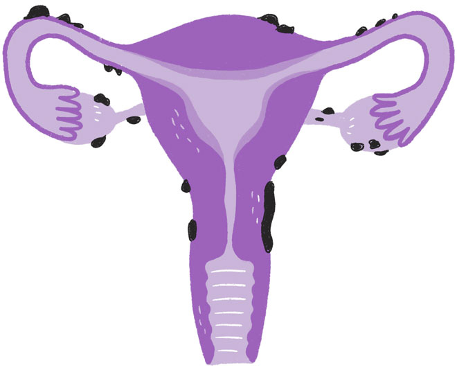 Иллюстрация к книге — Эндометриоз. Как разобраться в причинах и симптомах и позаботиться о себе в повседневной жизни [i_001.jpg]