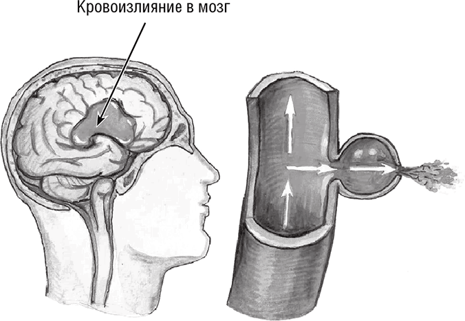 Иллюстрация к книге — Хрупкий мозг. Инсульту не быть? [img_15.jpg]
