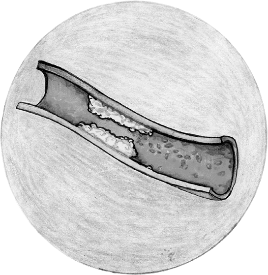 Иллюстрация к книге — Хрупкий мозг. Инсульту не быть? [img_16.jpg]