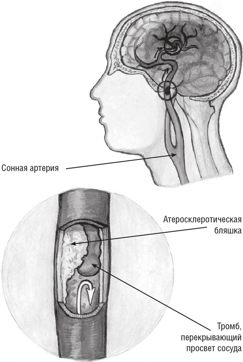 Иллюстрация к книге — Хрупкий мозг. Инсульту не быть? [img_18.jpg]