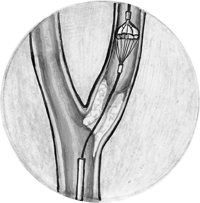 Иллюстрация к книге — Хрупкий мозг. Инсульту не быть? [img_38.jpg]