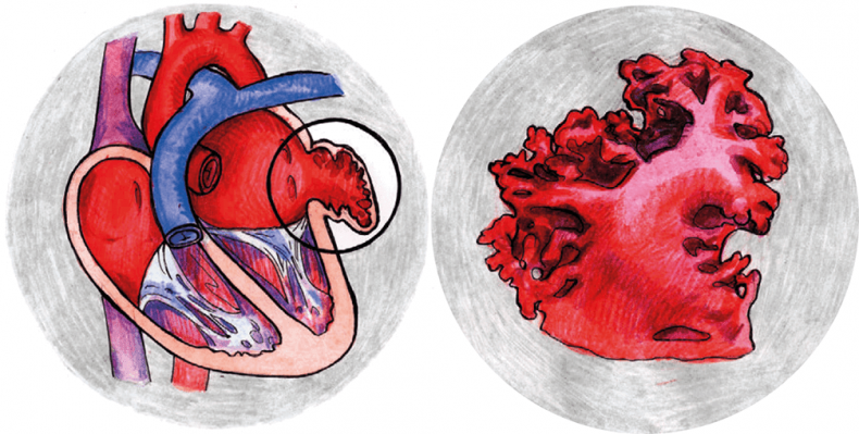 Иллюстрация к книге — Хрупкий мозг. Инсульту не быть? [img_40.jpg]