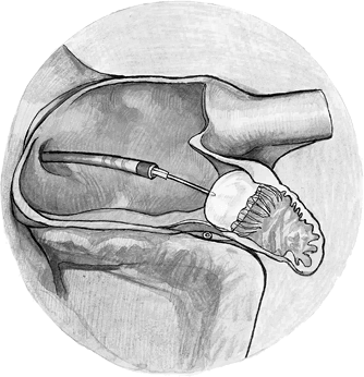 Иллюстрация к книге — Хрупкий мозг. Инсульту не быть? [img_42.jpg]