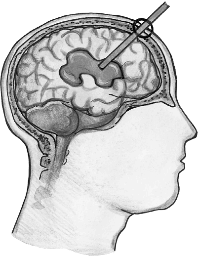 Иллюстрация к книге — Хрупкий мозг. Инсульту не быть? [img_64.jpg]