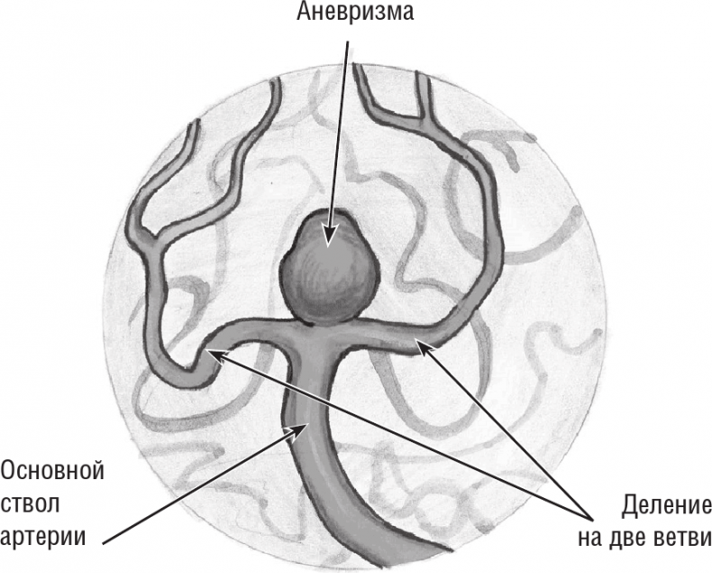 Иллюстрация к книге — Хрупкий мозг. Инсульту не быть? [img_71.jpg]