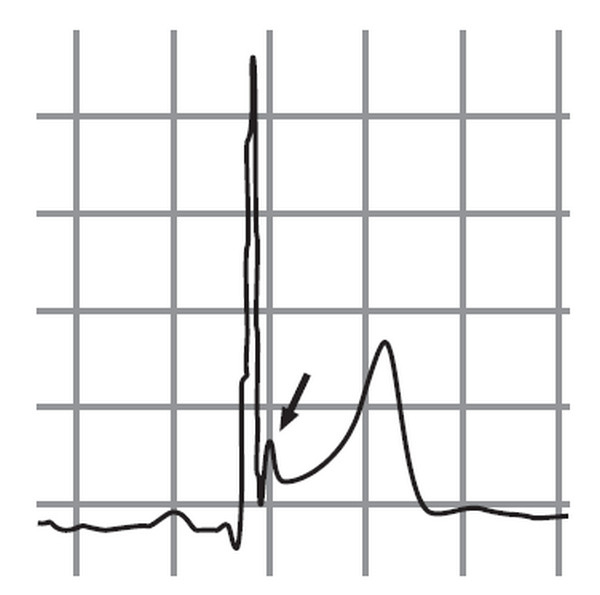 Иллюстрация к книге — Сердце спортсмена. Актуальные проблемы спортивной кардиологии [i_012.jpg]