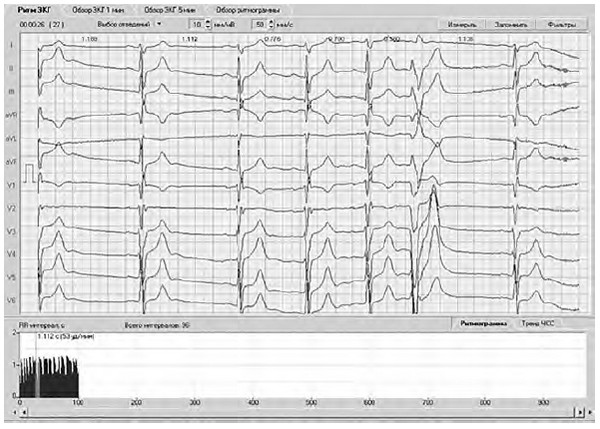 Иллюстрация к книге — Сердце спортсмена. Актуальные проблемы спортивной кардиологии [i_041.jpg]