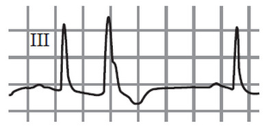 Иллюстрация к книге — Сердце спортсмена. Актуальные проблемы спортивной кардиологии [i_096.jpg]